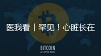 医我看丨罕见
！心脏长在右胸膛�！珠海成功开展首例“右位心”房颤射频消融术