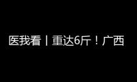 医我看丨重达6斤！广西女子乳腺肿瘤2年疯长至篮球大，医生提醒：这些情况务必重视