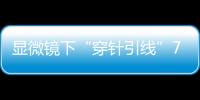 显微镜下“穿针引线”7小时！金湾这家医院成功帮患者保住断肢